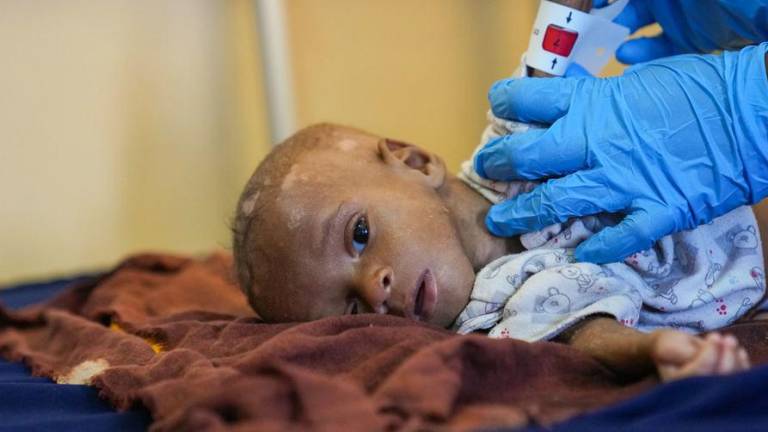 Un médico mide la circunferencia del brazo de Ibrahim, un niño de ocho meses que sufre desnutrición, en un hospital de Mogadiscio (Somalia).