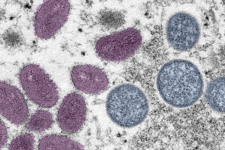 Reporta Secretaría de Salud tres nuevos casos positivos de viruela del mono en Sinaloa