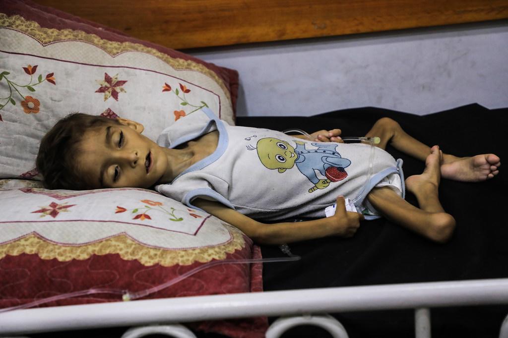 $!Un niño gravemente desnutrido ingresado en un hospital de la ciudad de Gaza.