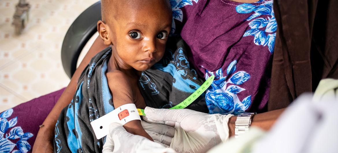 $!Este pequeño de un año con desnutrición grave recibe atención en un hospital de Dolow, Etiopía.