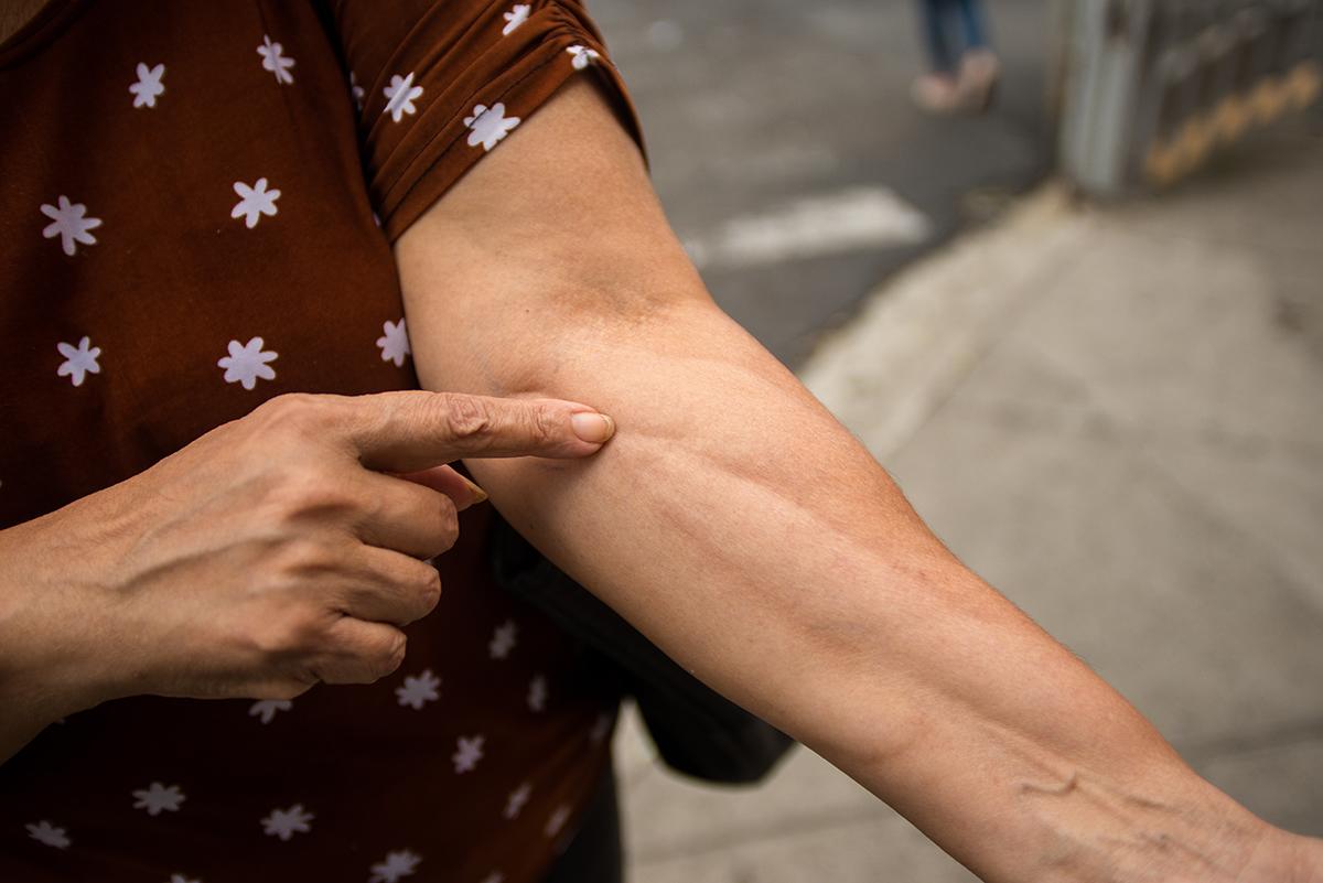$!Carolina Aguilar muestra las cicatrices en las venas que le han dejado las quimioterapias y los controles de sangre. Las molestias y el dolor se multiplican por los pinchazos frecuentes en la misma zona. Recibió su último tratamiento el año pasado.