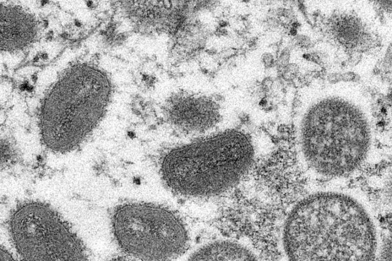 OMS no considera que viruela del mono llegue a ser pandemia