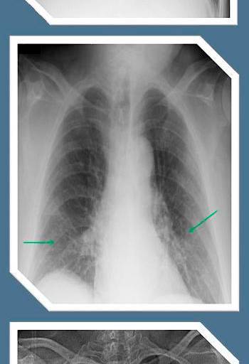 Decenas de miles sufren secuelas de Covid-19 en México y tendrá un alto costo