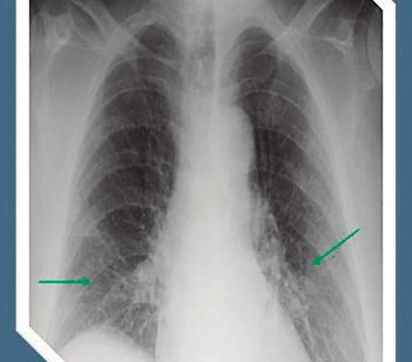 Decenas de miles sufren secuelas de Covid-19 en México y tendrá un alto costo