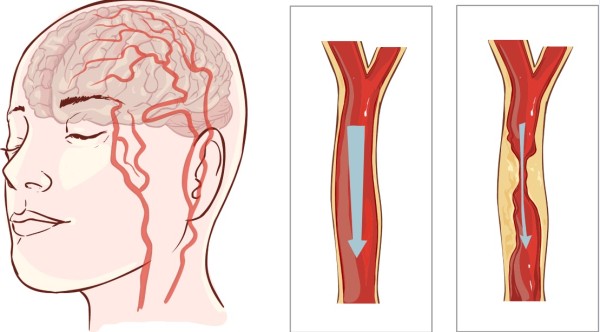 8 síntomas de un INFARTO CEREBRAL, qué hacer y cómo prevenir sus efectos