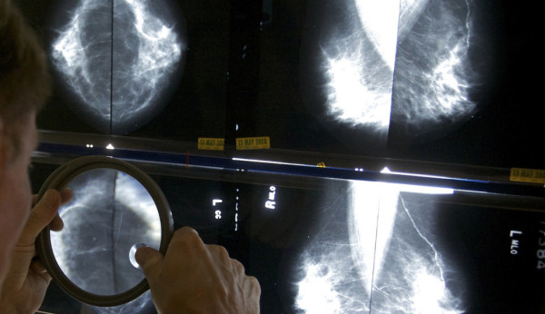 Científicos estadounidenses desaparecen tumores de mujer con cáncer de mama avanzado y metástasis
