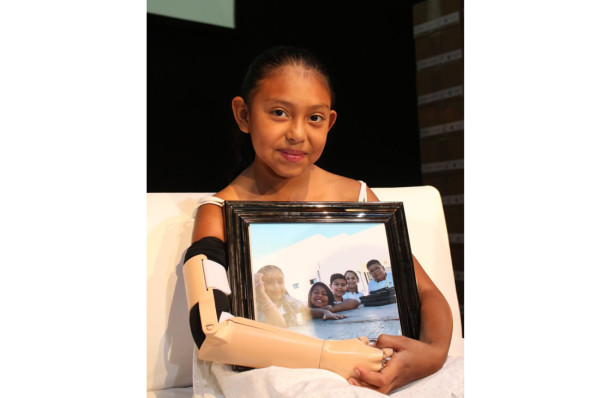 Ángela Dasha recibe una prótesis mecánica de brazo que le ayudará a mejorar su vida