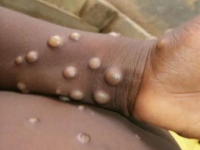 Ni OMS ni López-Gatell recomiendan vacunación masiva contra viruela del mono