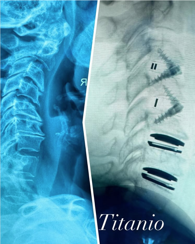 $!Muestra Alejandra Guzmán la radiografía de su columna tras delicada cirugía