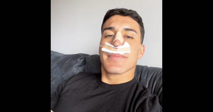 $!Alejandro Zendejas será operado tras fracturarse la nariz