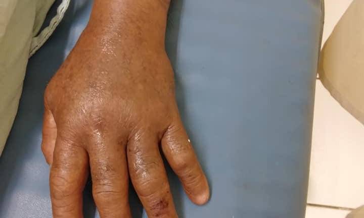 A don José, se le hincharon las extremidades por la acción del veneno