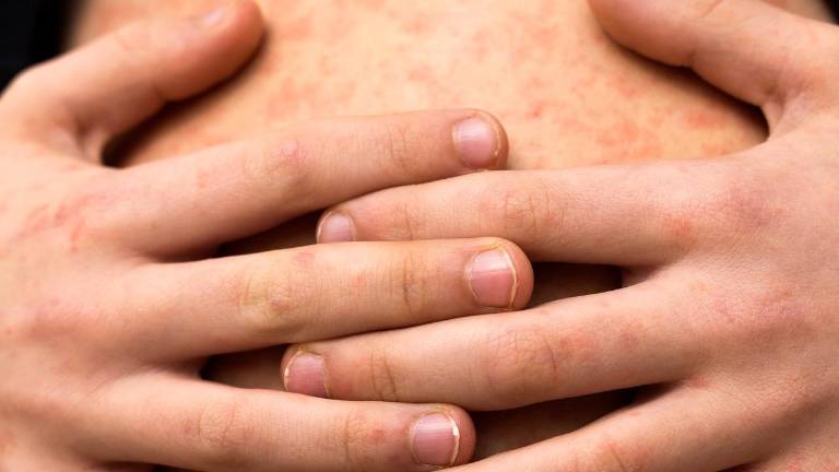 La Secretaría de Salud reiteró el llamado a revisar la Cartilla Nacional de Vacunación para prevenir contagios de sarampión.