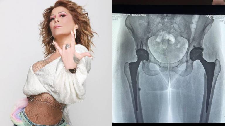 Alejandra Guzmán muestra radiografía de su cadera tras caída