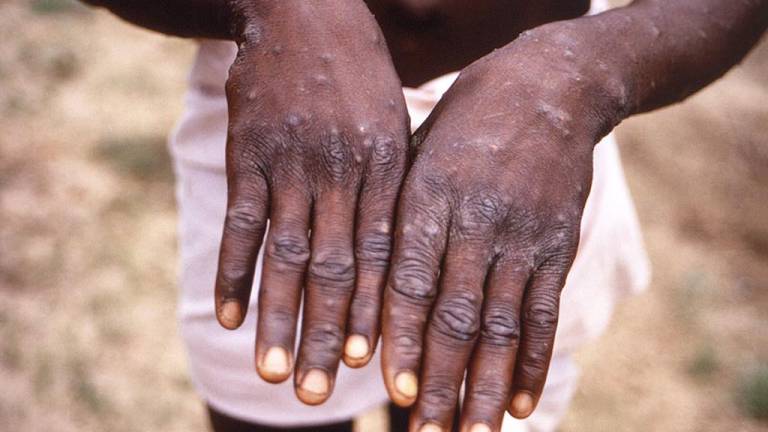 Joven muestra sus manos durante un brote de viruela del mono en la República Democrática del Congo.