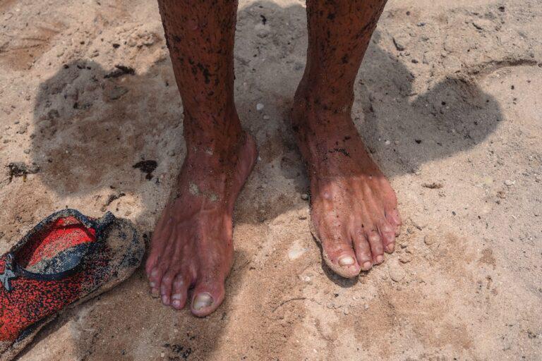 $!Los dedos de los pies de un trabajador con ampollas, producto de las quemaduras producidas por el contacto con el sulfuro de hidrógeno.