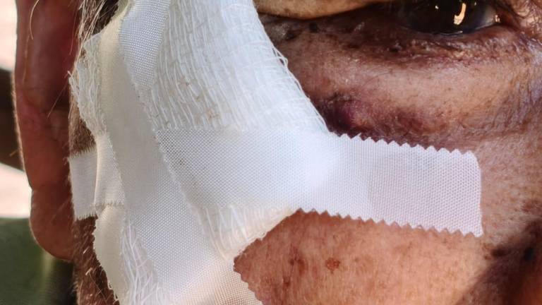 El paciente es uno de los dos casos de infestación por gusano barrenador en seres humanos registrados por las autoridades de Salud en Sinaloa.