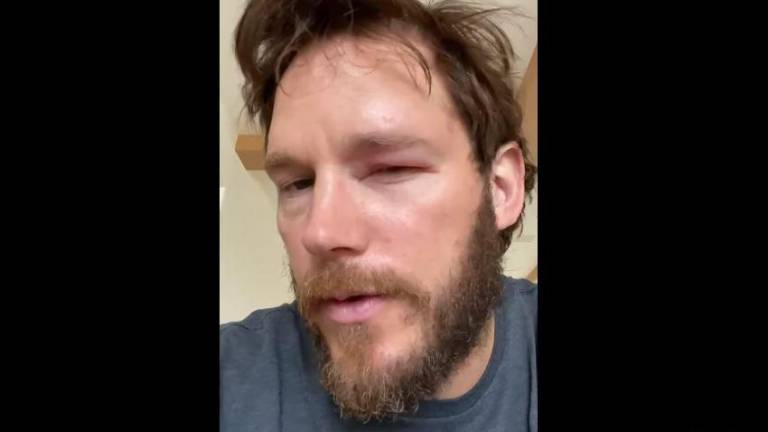 Culpa Chris Pratt a apicultora por picadura de abeja en su ojo