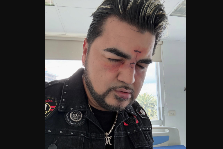 Causa alarma ‘El Mimoso,’ al aparecer con golpes en el rostro en sus redes sociales