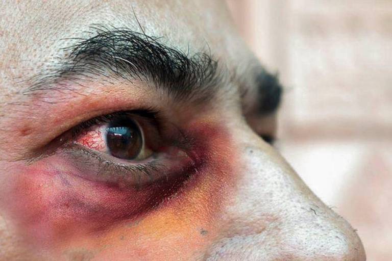 Con la pandemia del Covid se ha hablado también del hongo negro, pero, ¿a quiénes afecta?