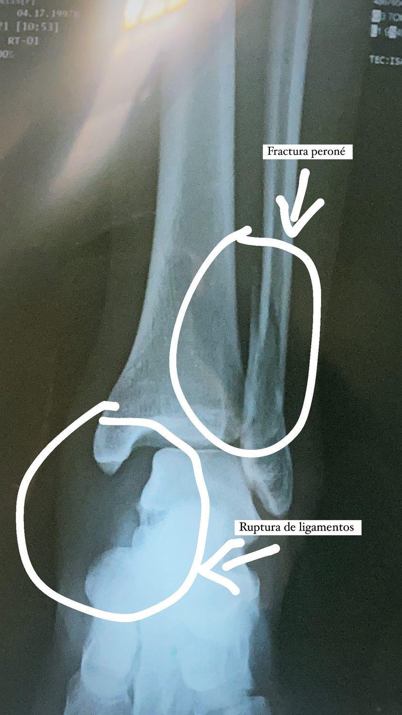 $!Operan con éxito a Melisa Ramos, del Mazatlán FC Femenil