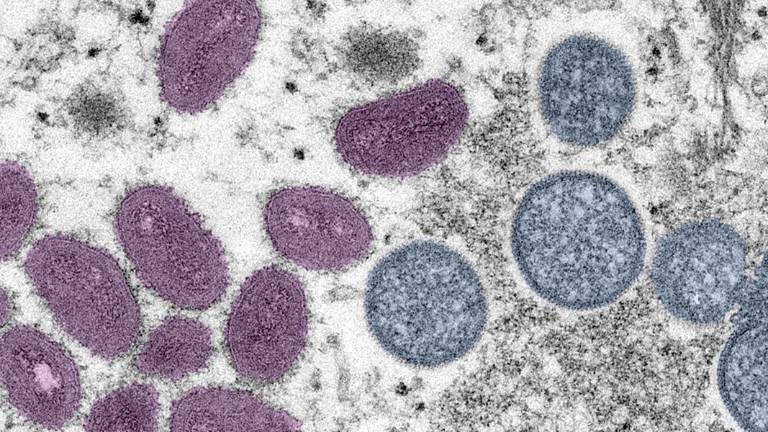 Con estos nuevos casos suman un total de ocho pacientes en Sinaloa que han resultado portadores de viruela de mono desde el pasado mes de julio.