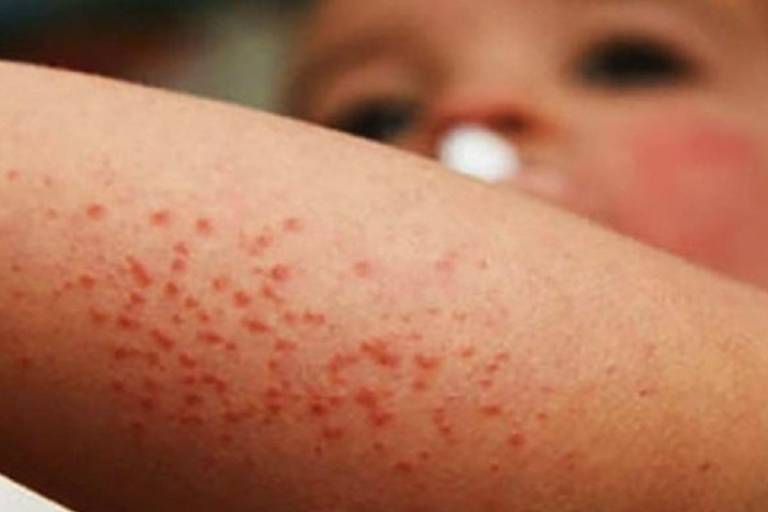 Suman 4 defunciones por sarampión en México, 3 en Chihuahua y 1 en Sonora