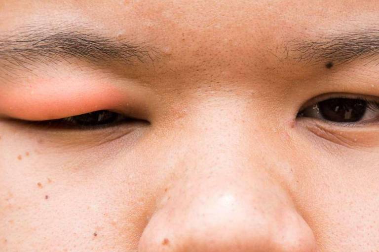 Con la pandemia del Covid se ha hablado también del hongo negro, pero, ¿a quiénes afecta?