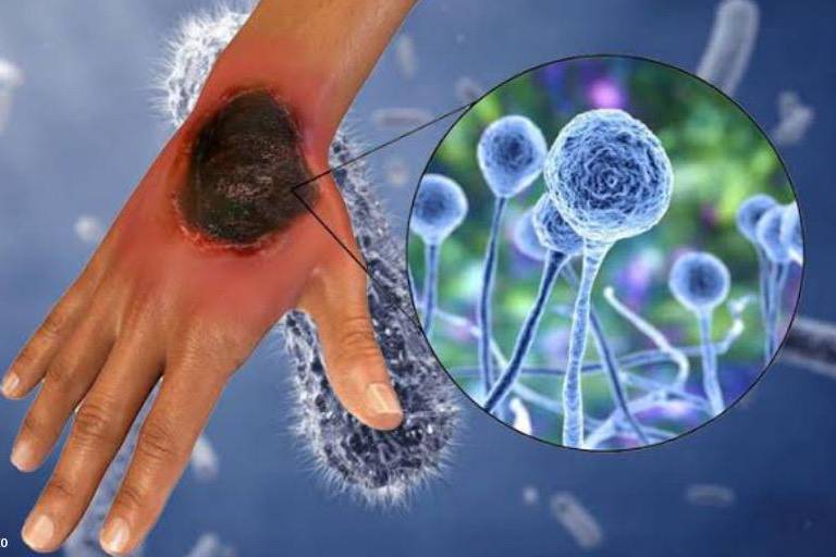 Oaxaca tiene 2 casos sospechosos de hongo negro; tuvieron Covid-19