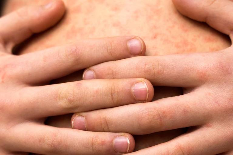 Durante 2025, Sinaloa ha registrado 14 casos de sarampión: Salud