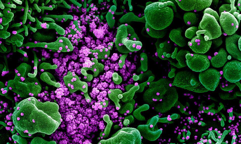 $!Una imagen digitalmente aumentada de una muestra de un paciente presenta células verdes muy infectadas con la partícula de virus SARS-CoV-2 de color púrpura.