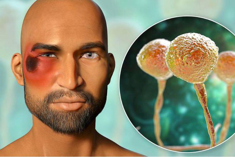 Con la pandemia del Covid se ha hablado también del hongo negro, pero, ¿a quiénes afecta?